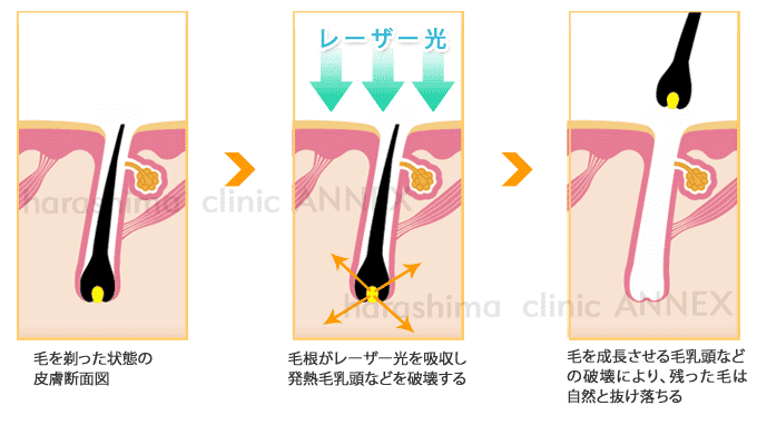 医療レーザー脱毛